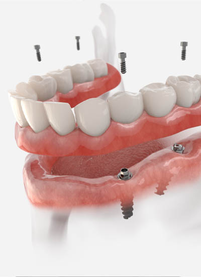 Implant-Supported Dentures