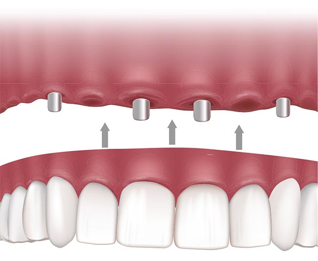 WHAT ARE IMPLANT-SUPPORTED DENTURES?