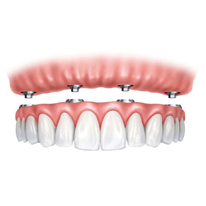 Implant Restoration