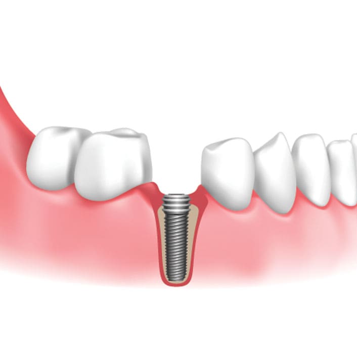 Implant Supported Dentures
