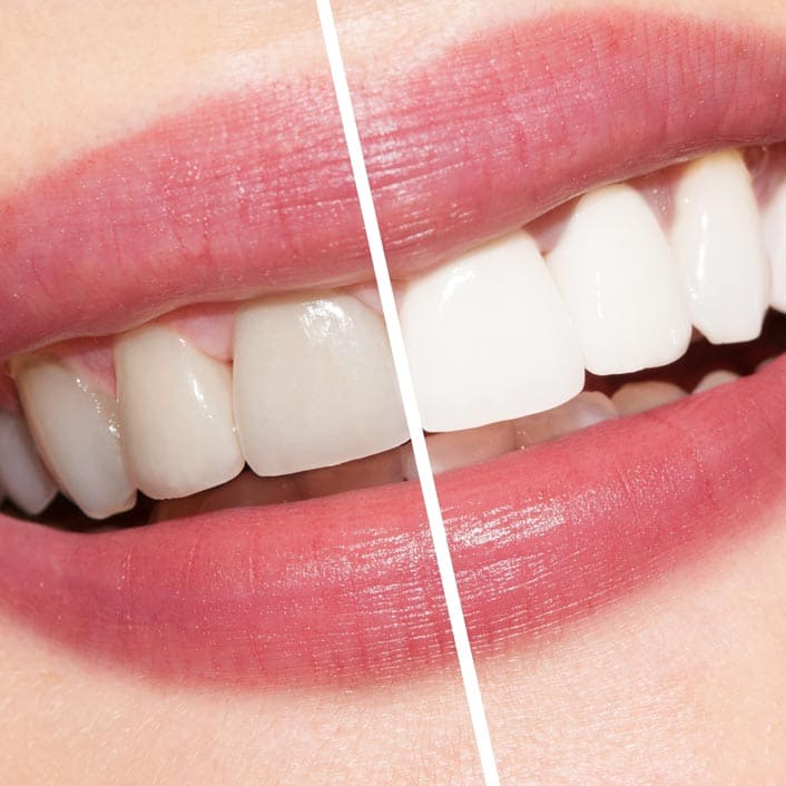 Teeth Whitening Trays